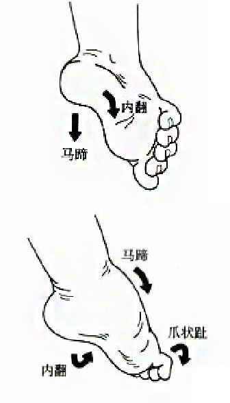 马蹄足