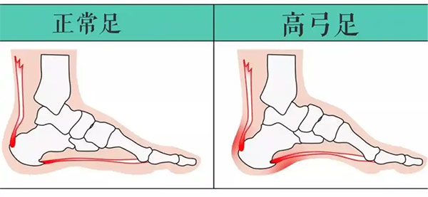 高弓足1