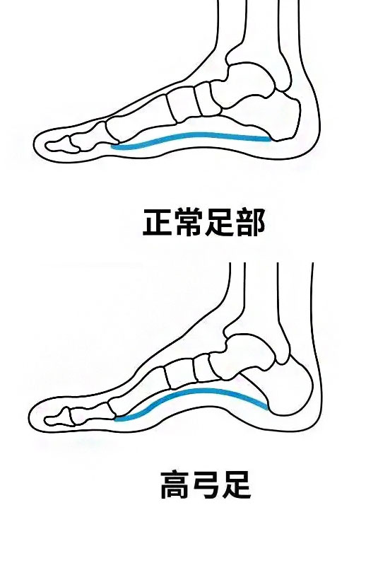 高弓足